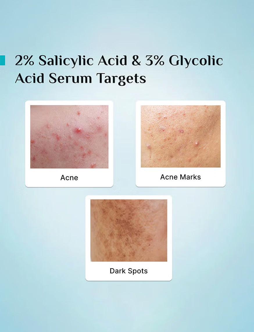Pilgrim Anti Acne Serum With Salicylic & Glycolic Acid For Dark Spots